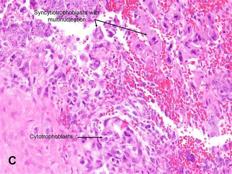 Testicle choriocarcinoma