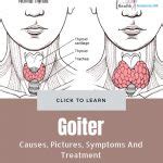 Goiter - Causes, Pictures, Symptoms And Treatment