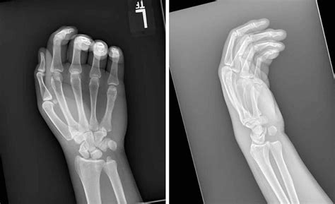 Cureus | Isolated Volar Dislocation of the Distal Radioulnar Joint Treated With Successful ...