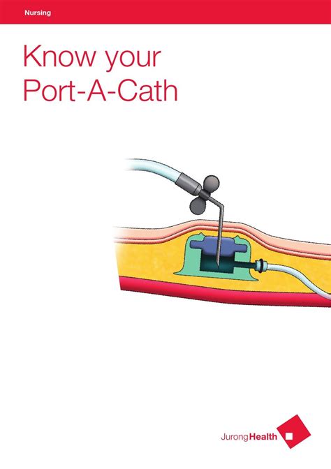 Nursing - Knowing your Port-A-Cath by JurongHealth Campus - Issuu