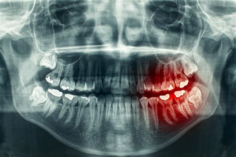 Oral Surgeons Share 3 Common Symptoms of Jaw Cancer - Oral Surgery Associates of Alaska, LLC ...