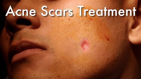 Dermabrasion For Acne Scars - YouTube