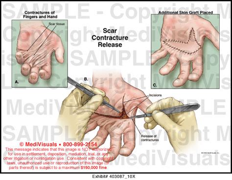 Medivisuals Scar Contracture Release Medical Illustration