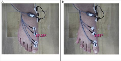 Angle of first MTP joint during SF exercise (A) and TSO exercise (B ...