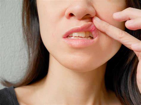 What Are the Different Types of Canker Sores?