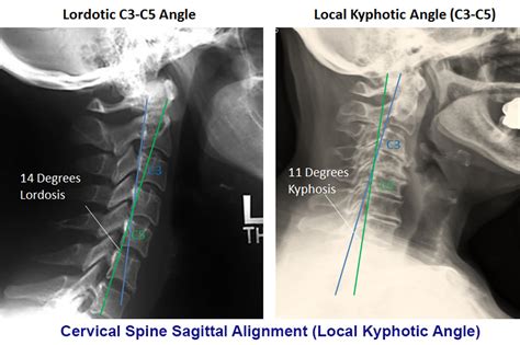 Cervical Myelopathy - Spine - Orthobullets