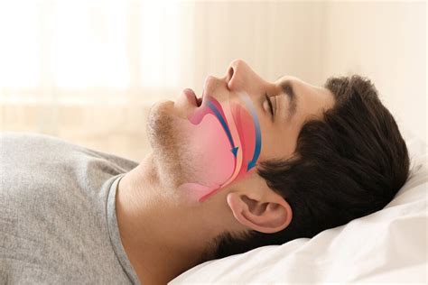 Alternatives to Surgery for Sleep Apnea Treatment