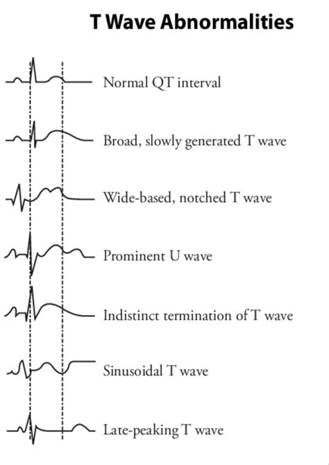 T wave abnormalities | Medical school essentials, Cardiac nursing, Medical knowledge