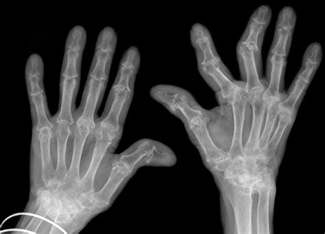 Rheumatoid Arthritis: The 4 Stages of Rheumatoid Arthritis