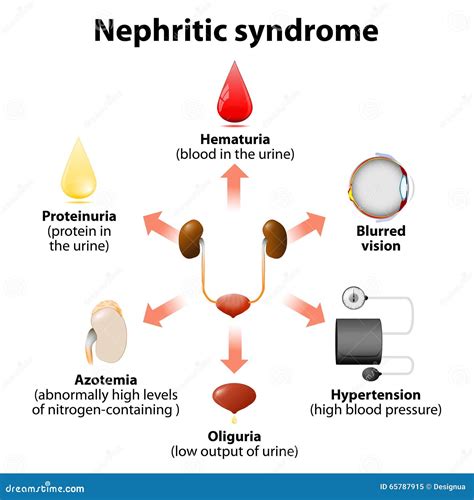 Nephritic Syndrome Stock Vector - Image: 65787915