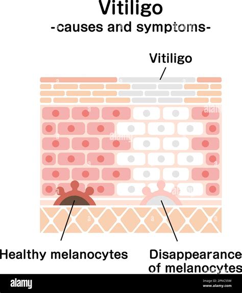 Causes and symptoms of Vitiligo vector illustration Stock Vector Image ...