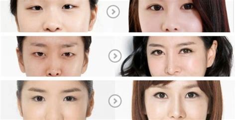 6 Before and After Korean Eyes Surgery Pictures | Seoul TouchUp’s Favourites Of The Week - Seoul ...