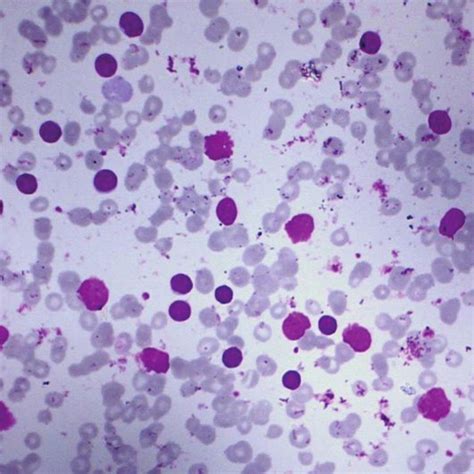 Type of B–cell lymphoproliferative disorders; Legend: CLL –chronic... | Download Scientific Diagram