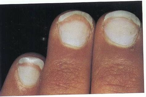 Kidney disease and fingernails - Awesome Nail