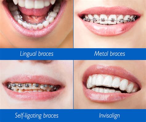 Damon Self-Ligating Braces Explained - Yonkers, Bronx, NY