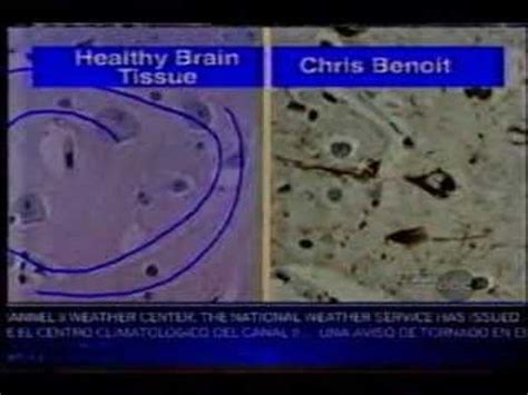 Tissue samples of the damaged brain of Chris Benoit, a famous WWE wrestler who murdered his ...