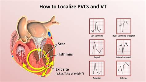 Ecg Clues For Diagnosing Ventricular Tachycardia Mechanism | sexiezpix Web Porn