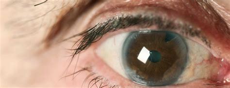 Immature Cataract: Meaning, Symptoms And Tips To Manage