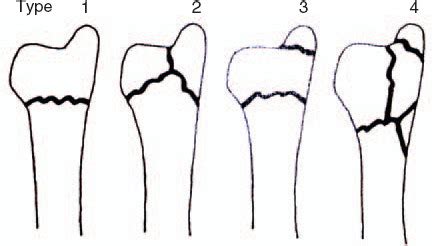 FRYKMAN CLASSIFICATION OF Radiology Classroom Facebook, 56% OFF