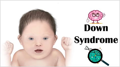 Down Syndrome Symptoms