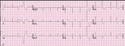 Dr. Smith's ECG Blog: Wellens' missed. Then returns with Wellens' with ...