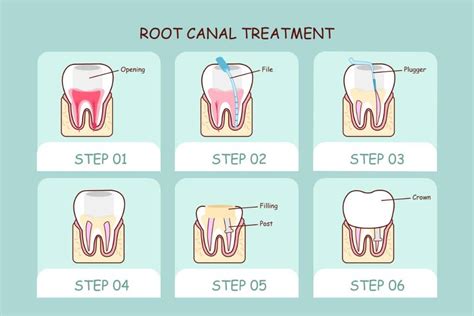 Are Root Canals Safe, & Do Root Canals Cause Cancer? - Sarasota Dentistry