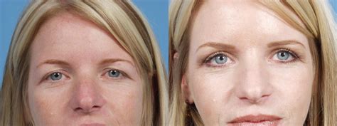 Eyelid Surgery Before and After Pictures Case 62 | Chicago, IL | TLKM Plastic Surgery