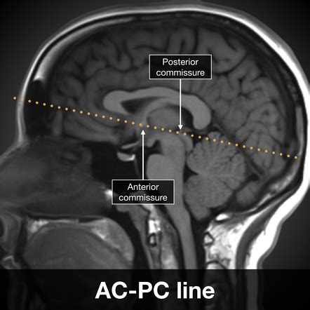 Anterior commissure - posterior commissure line | Radiology Reference ...