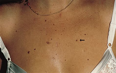 A 10-Year-Old In Situ Melanoma? | Dermatology | JAMA Dermatology | The JAMA Network