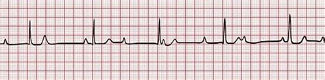 ECG Class - Keeping ECGs Simple: Autumn 3—Heart Blocks