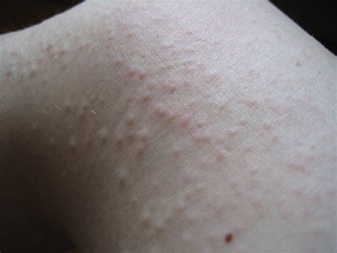 Relief For Hives: Chronic Hives