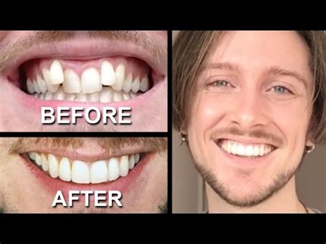 INVISALIGN REVIEW - everything you need to know - YouTube