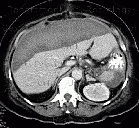 SUBCAPSULAR HEMATOMA LIVER ULTRASOUND - Wroc?awski Informator ...