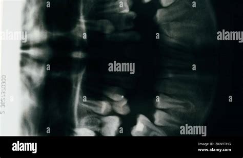 Jaw x-ray close-up. Magnetic Resonance Image of theeth. Doctor examining xray of Stock Video ...