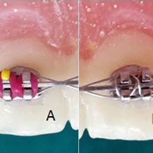 (PDF) Various types of ligation ties in orthodontics