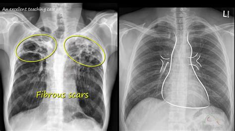 Chest x ray - Tuberculosis healed, (TB), Inactive TB - YouTube