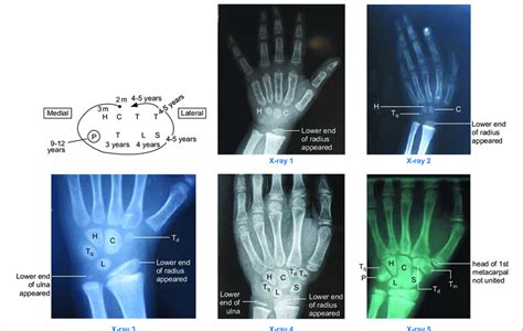 Carpal Bones Ossification : Mnemonic | medicomaestro