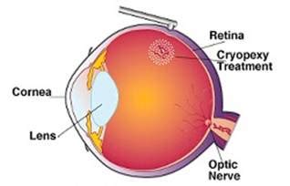 Cryopexy | Premier Eye Care | Long Island NY | Island Retina