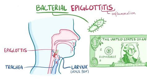 Bacterial epiglottitis: Video, Anatomy & Definition | Osmosis