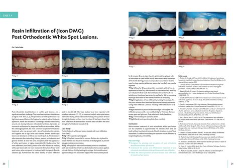 Resin Infiltration of (Icon DMG) Post Orthodontic White Spot Lesions by Henry Schein Australia ...