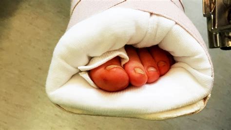 Morton's Neuroma Surgery: Learn everything about it and recovery