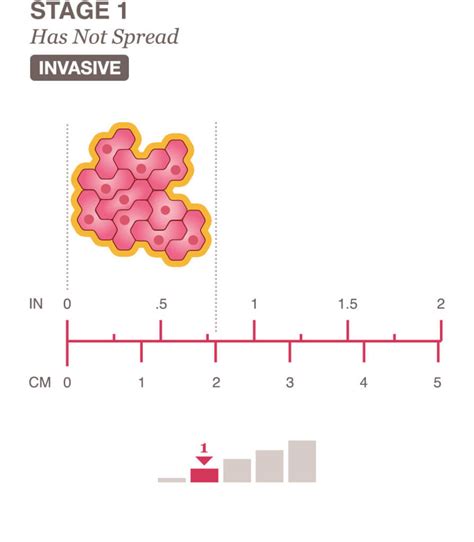 Stages 0 & 1 Breast Cancer Overview - National Breast Cancer Foundation