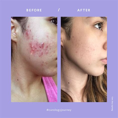 Acne Results | Phony, Things to think about, Acne