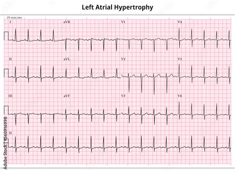 ECG Left Atrial Hypertrophy (LAH) - Left Atrial Enlargement (LAE) - 12 Lead ECG Common Case - 3 ...