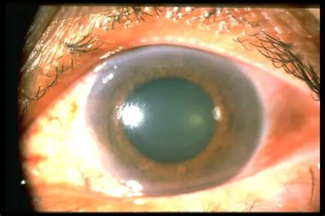 Acute angle-closure glaucoma - American Academy of Ophthalmology