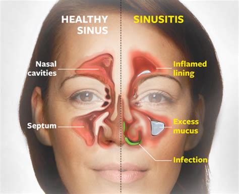 What You Should Know About Sinus Headache Symptoms