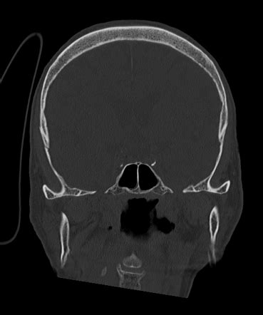 Temporal bone fracture and contrecoup injury - subtle | Radiology Case ...