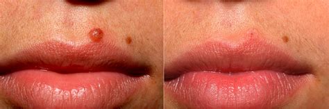 Flat Mole On Lip Removal | Sitelip.org