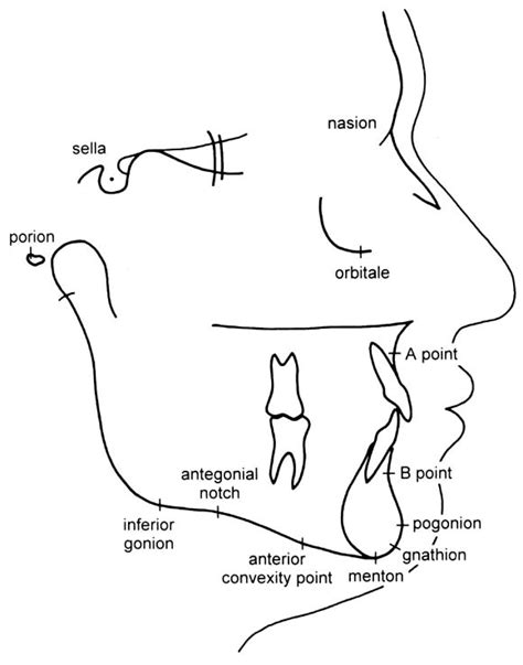 Evaluation of antegonial notch depth for growth prediction - American Journal of Orthodontics ...