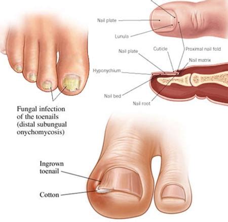 Toenail Fungus Treatment in NYC | Manhattan Foot Specialists